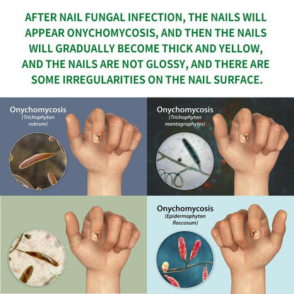 JAYSUING Ginger Nail Treatment