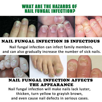 JAYSUING Ginger Nail Treatment