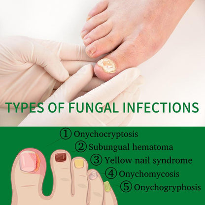 JAYSUING Ginger Nail Treatment